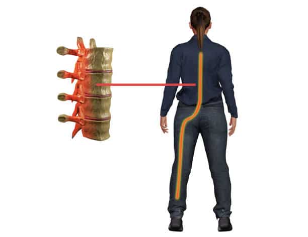 Sciatica pain, a symptom of disturbance in the nerve of the spine, reaches the leg and causes discomfort. 3d illustration