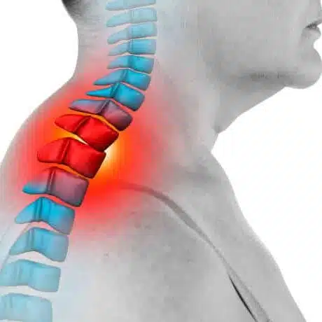 Upper Cervical Subluxation medical illustration of a human 