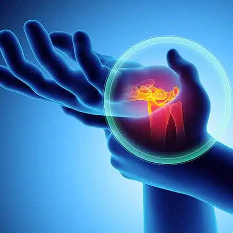 medical 3D illustration of Carpal Tunnel Syndrome