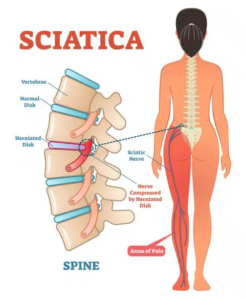 Sciatica medical health care vector illustration scheme with lower spine and sciatic nerve pain in leg.