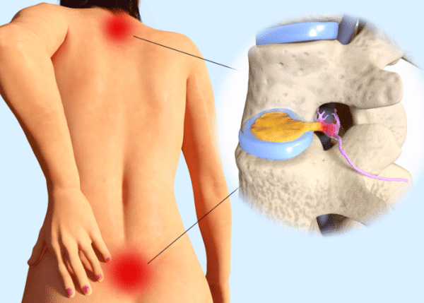 Medical illustration of a human with Bulging or herniated disc.