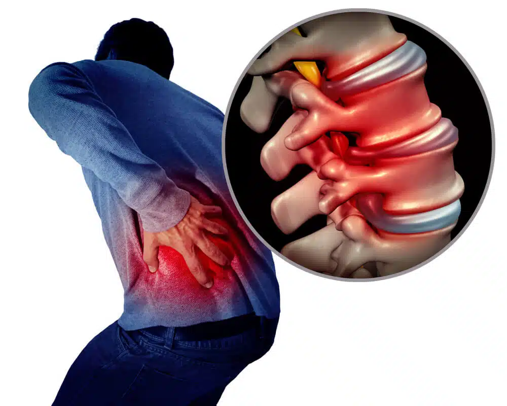 Medical Illustration of a man having a spinal disc problem, back pain.