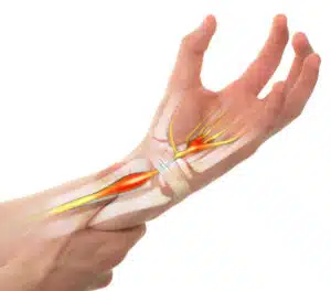 Medical illustration of a human wrist that suffers from carpal tunnel syndrome.